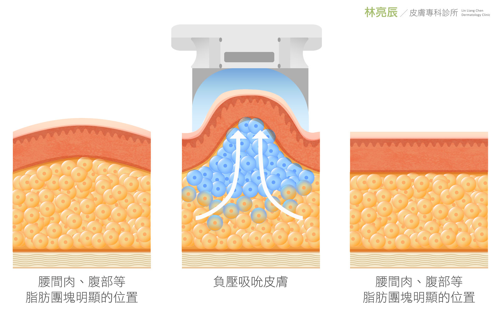 CoolSculpting Elite 酷塑冷凍減脂利用脂肪細胞怕冷特性，非侵入地以低溫「選擇性」去破壞脂肪細胞