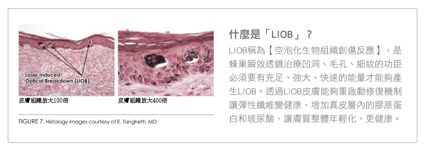 鉑金蜂巢皮秒雷射搭載的鉑金蜂巢透鏡刺激皮膚LIOB作用