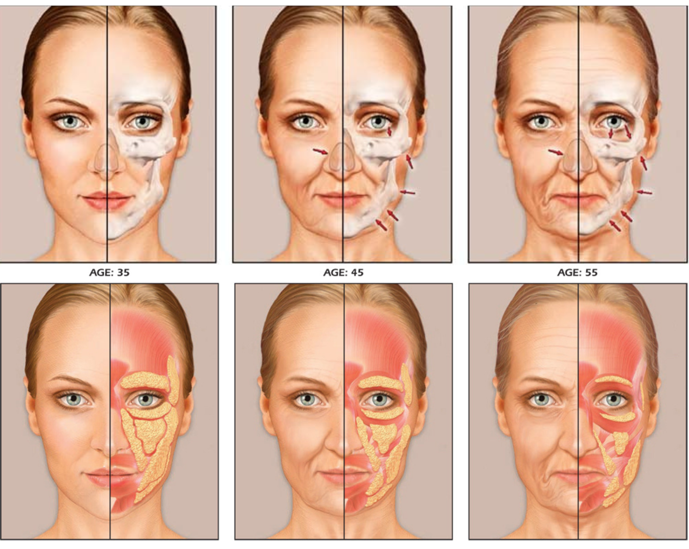老化是源自於臉部骨架改變與匴組織流失位移