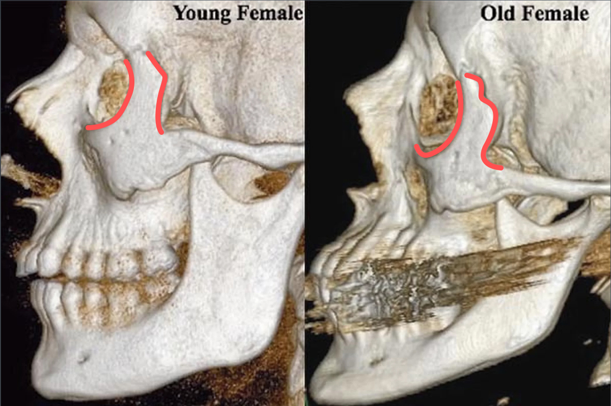 臉部老化導致整體骨架流失後退 觀察到眼眶骨變寬