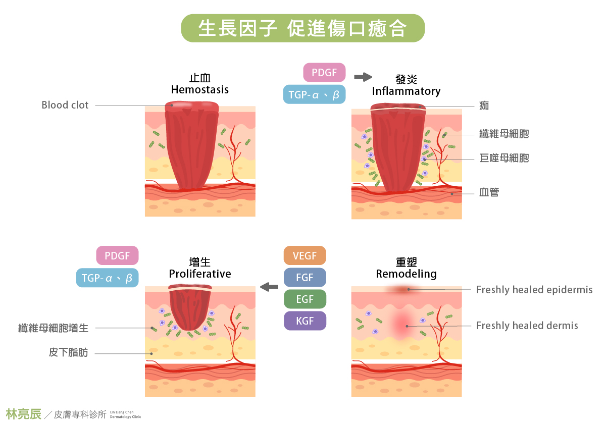 血小板富含生長因子可以幫助傷口癒合