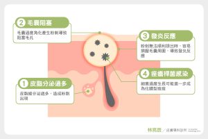 使用醫皮痘之前先認識痘痘發生原因，是因為毛囊和皮脂腺堵塞，導致發炎反應