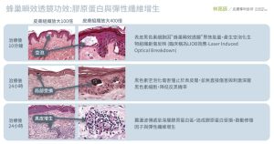 蜂巢透鏡在皮秒雷射治療中起到了關鍵的作用。