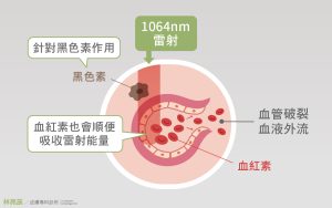 1064nm波長因為清除黑色素同時能量也會被血紅素吸收導致皮下出血術後希求更長