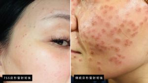 755皮秒雷射與淨膚雷射比較結痂更輕薄