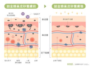 鉑金皮秒養膚前後