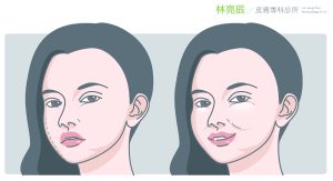 什麼是「饅化臉」？什麼原因造成的？
