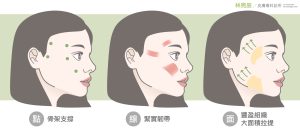 林亮辰醫師提出減齡三部曲-以4D童妍針(Sculptra)強調「點、線、面」分區階段治療