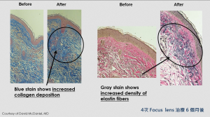 鉑金蜂巢透鏡數次治療新生肌原蛋白肌膚年輕化