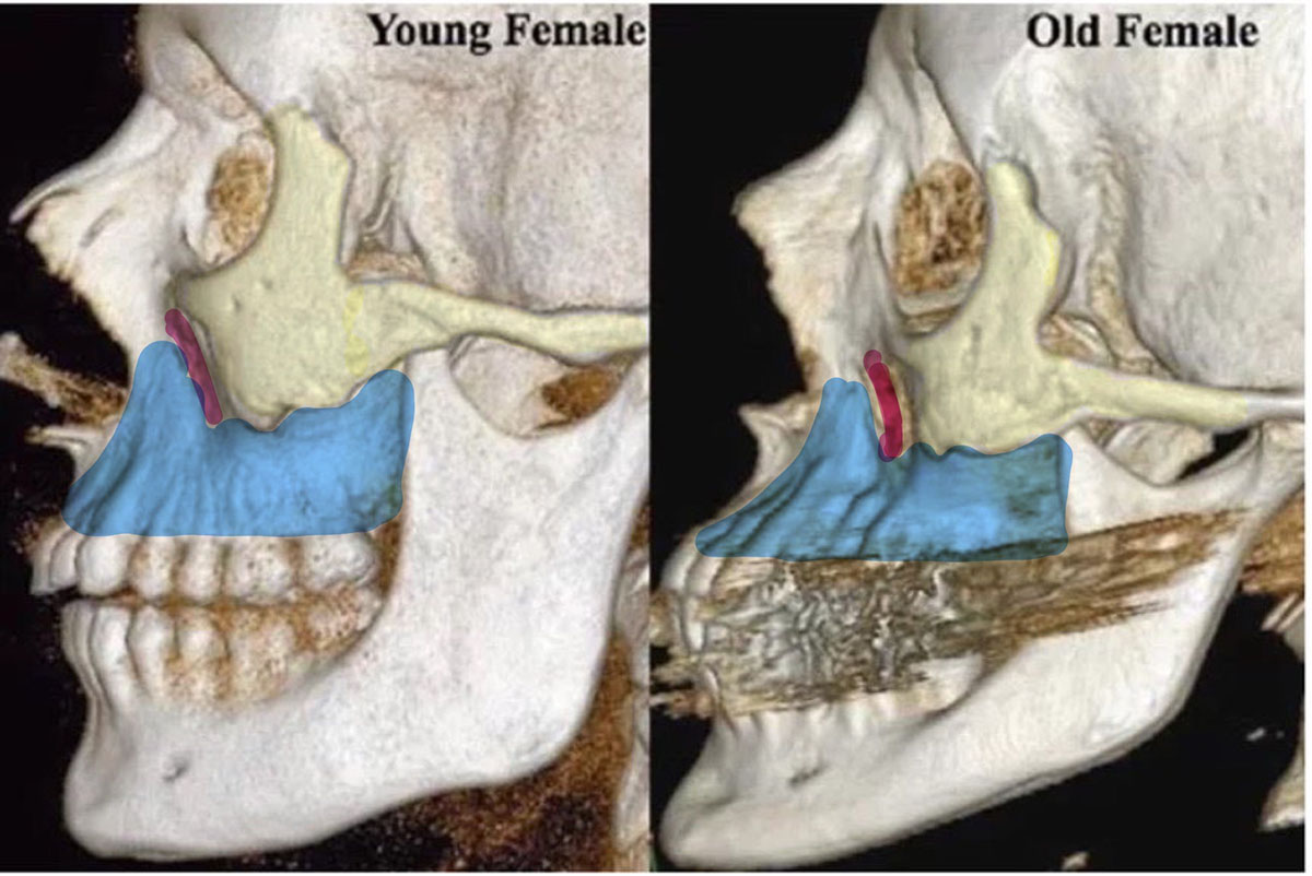 法令紋的原因主要源自骨架流失尤其是上頜骨