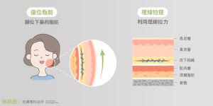 埋線拉提治療法令紋可以讓下垂的脂肪歸位