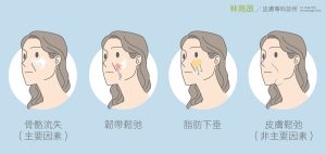 法令紋成因與骨架流失韌帶鬆弛脂肪下垂皮膚鬆弛有關係