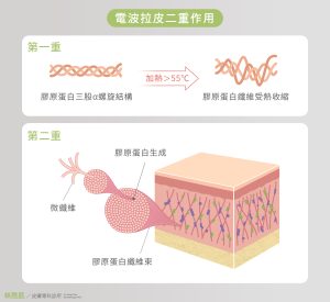 鳳凰電波施打後會有二重作用包含施打當下與後續新生膠原蛋白