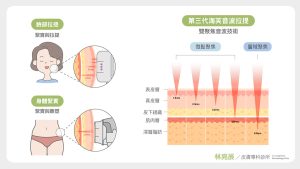 音波拉提針對鬆弛的筋膜層拉提對於法令紋改善效果不顯著
