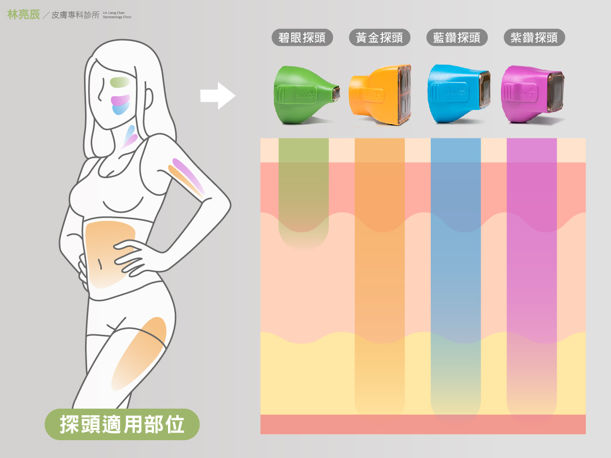 鳳凰電波不同探頭作用在不同深部因此適用不同部位而這些也會以想電波拉皮價格