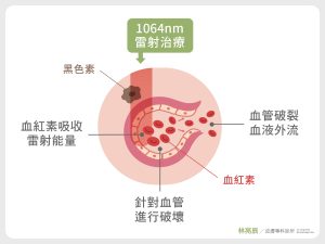 1064nm波長 因為清除黑色素同時同會能量會被血紅素吸收造成皮下出血修復期更長