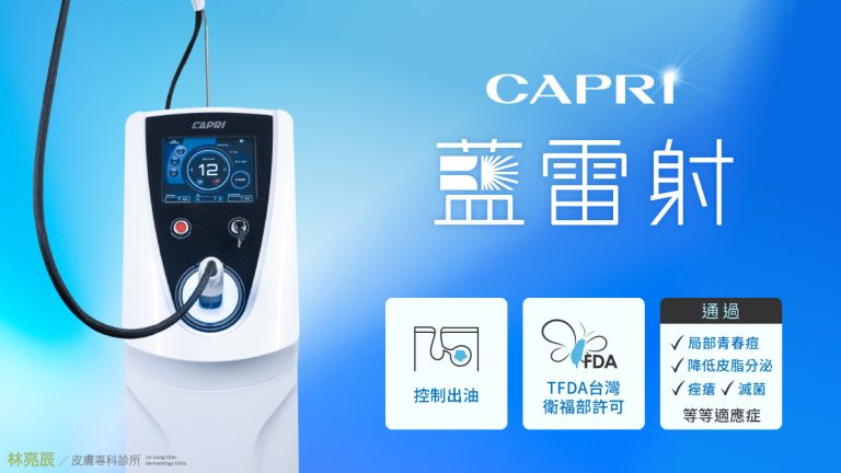 CAPRI acne laser