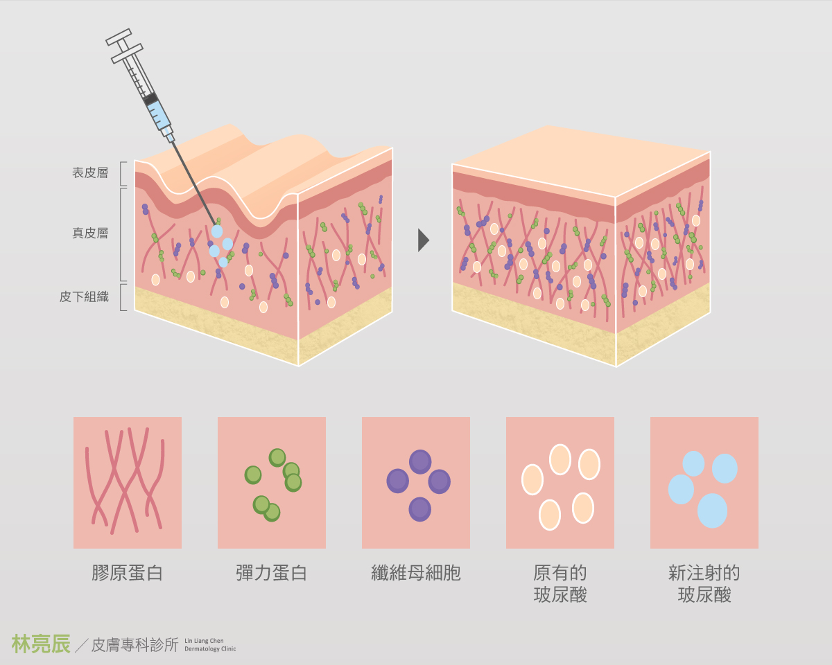 Skin Booster將玻尿酸及4D童妍針注射真皮層可以活粗纖維母細胞