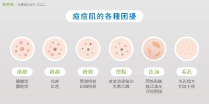 痘痘肌除了痘痘本身也會有粉刺出油及色素沈澱痘疤