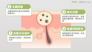 青春痘發生的原因包含皮脂腺過於旺盛以及毛孔阻塞等多種原因