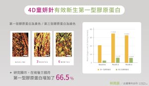 4D童顏針在術後三個月有效新生第一型膠原蛋白