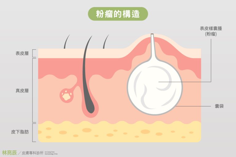 粉瘤的正式名稱是表皮囊腫 - 林亮辰皮膚專科診所 Bright Skin