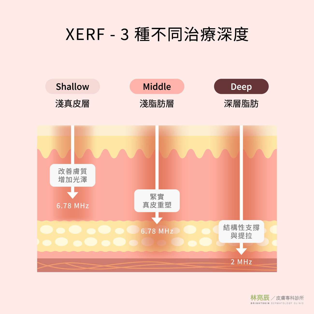 XERF 電波三種治療深度模式：淺真皮層、淺脂肪層與深層脂肪。