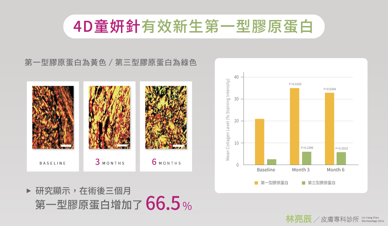 4D童妍針臨床組織切片與數據圖，證實術後三個月第一型膠原蛋白顯著增加66.5%，強化肌膚結構支撐力。